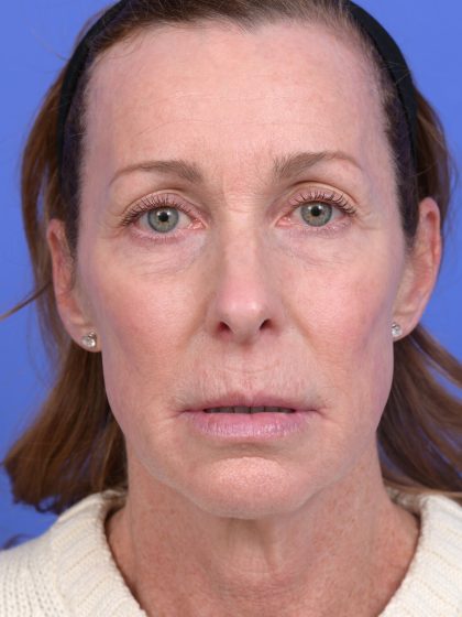 Lower Deep Plane Facelift Before & After Patient #10640