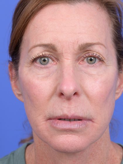 Lower Deep Plane Facelift Before & After Patient #10640