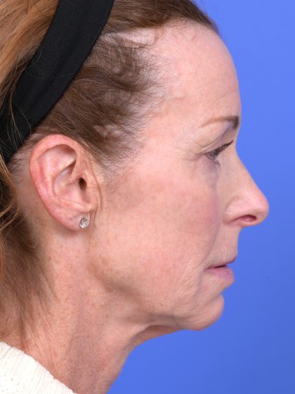 Lower Deep Plane Facelift Before & After Patient #10640