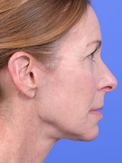 Lower Deep Plane Facelift Before & After Patient #10640