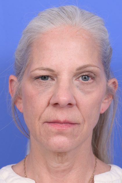 Lower Deep Plane Facelift Before & After Patient #10638