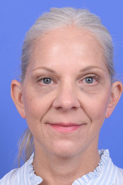 Lower Deep Plane Facelift Before & After Patient #10638