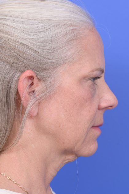 Lower Deep Plane Facelift Before & After Patient #10638
