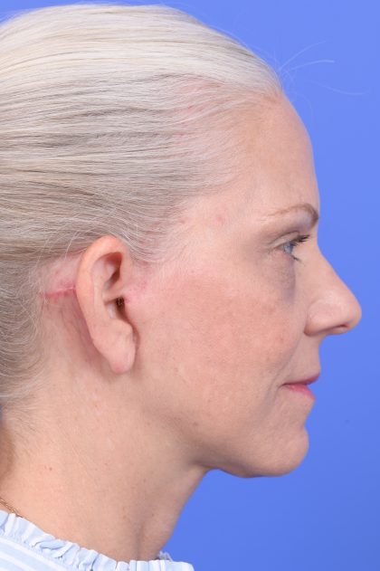 Lower Deep Plane Facelift Before & After Patient #10638
