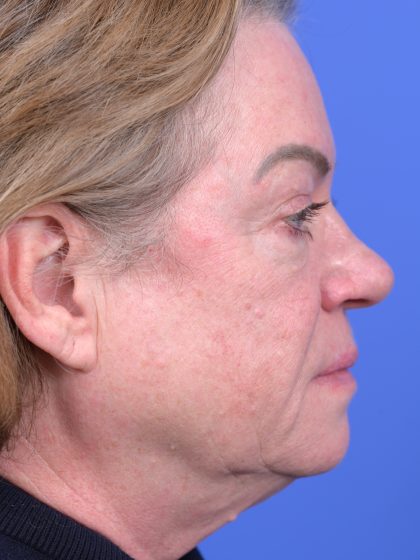 Vertical Midface Lift Before & After Patient #10646