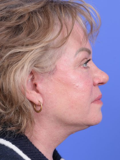 Vertical Midface Lift Before & After Patient #10646