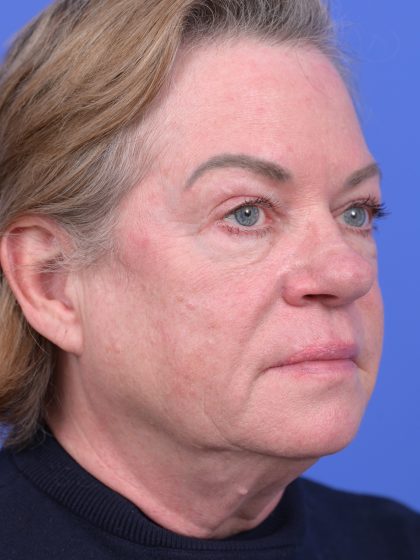 Vertical Midface Lift Before & After Patient #10646