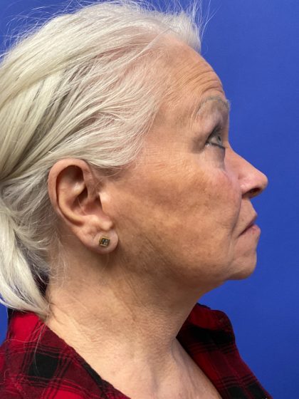 Upper Blepharoplasty Before & After Patient #10635