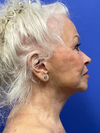 Upper Blepharoplasty Before & After Patient #10635
