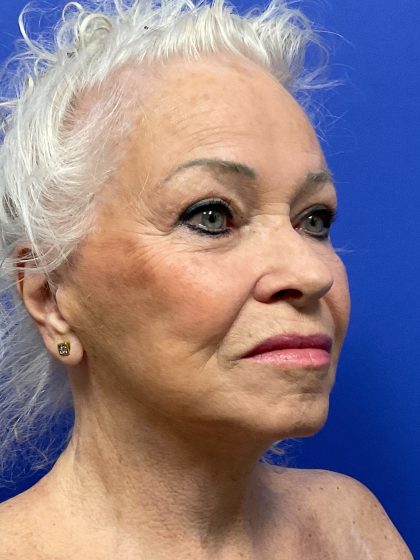 Upper Blepharoplasty Before & After Patient #10635