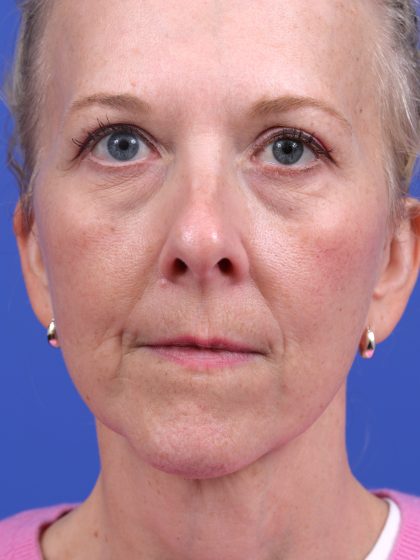 Neck Liposuction Before & After Patient #10634