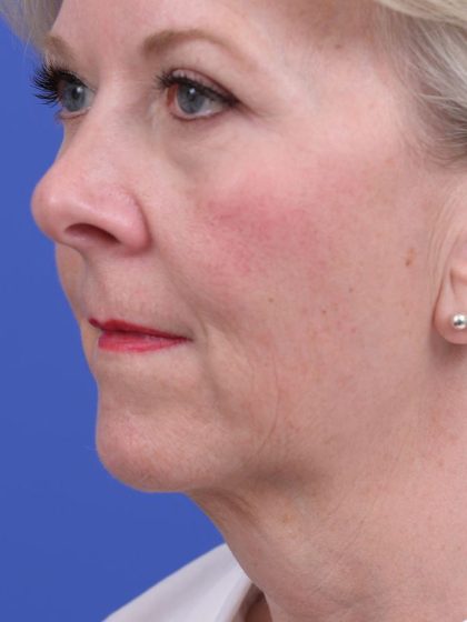 Neck Liposuction Before & After Patient #10634