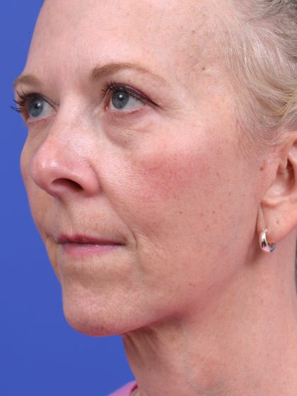 Neck Liposuction Before & After Patient #10634