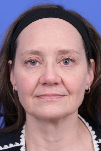 Vertical Midface Lift Before & After Patient #10643