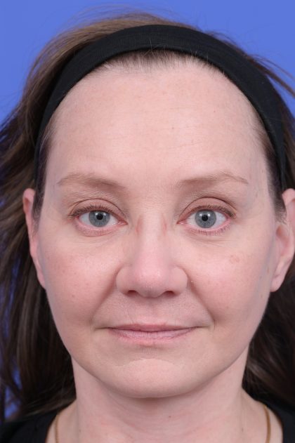 Vertical Midface Lift Before & After Patient #10643