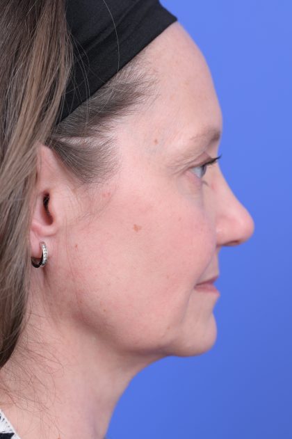 Vertical Midface Lift Before & After Patient #10643