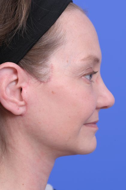 Vertical Midface Lift Before & After Patient #10643