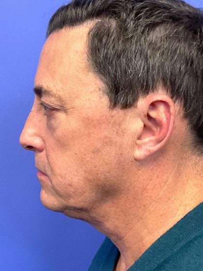 Lower Deep Plane Facelift Before & After Patient #10650