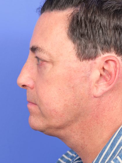 Lower Deep Plane Facelift Before & After Patient #10650
