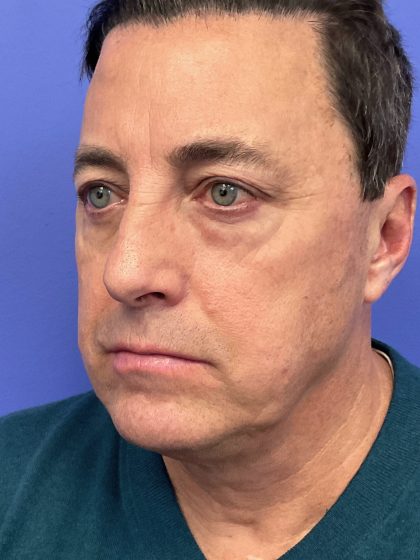 Lower Deep Plane Facelift Before & After Patient #10650