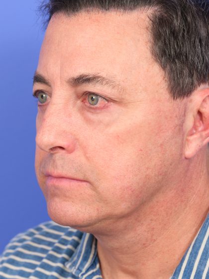 Lower Deep Plane Facelift Before & After Patient #10650