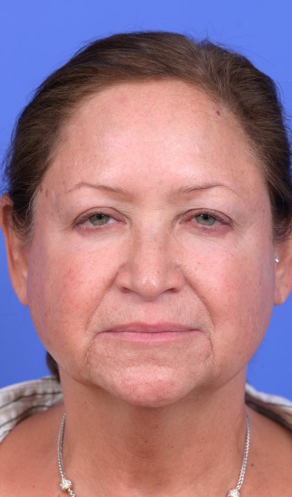 Upper Blepharoplasty Before & After Patient #10649