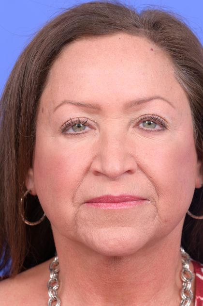 Upper Blepharoplasty Before & After Patient #10649