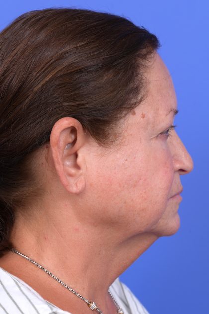 Upper Blepharoplasty Before & After Patient #10649