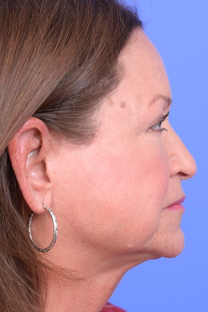 Upper Blepharoplasty Before & After Patient #10649