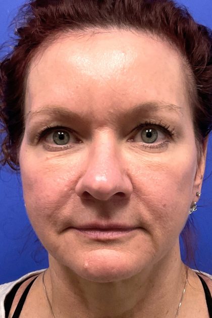 Upper Blepharoplasty Before & After Patient #10645