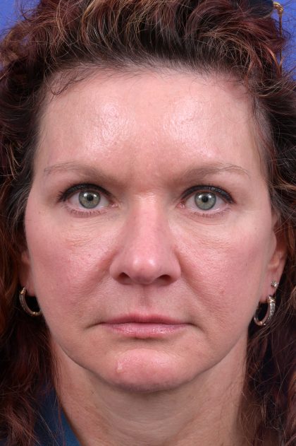 Upper Blepharoplasty Before & After Patient #10645