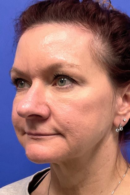 Upper Blepharoplasty Before & After Patient #10645