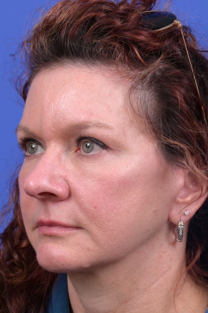 Upper Blepharoplasty Before & After Patient #10645