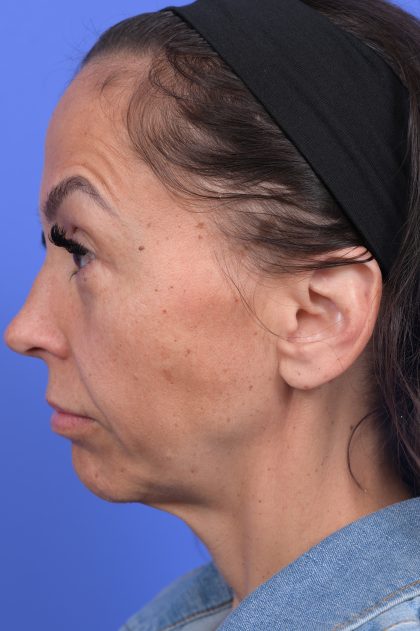 Platysmaplasty Before & After Patient #10641