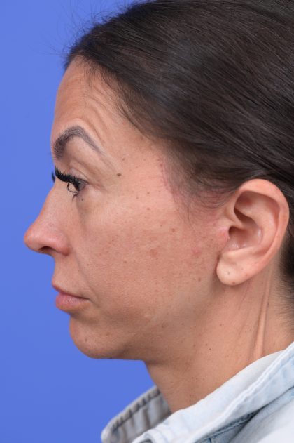 Platysmaplasty Before & After Patient #10641
