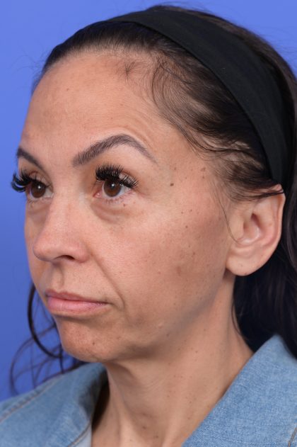 Platysmaplasty Before & After Patient #10641