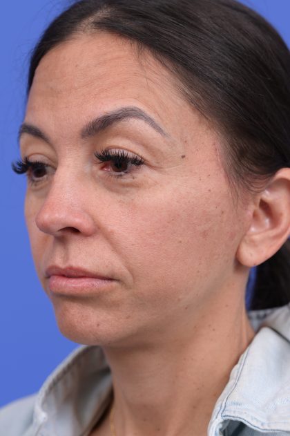 Platysmaplasty Before & After Patient #10641