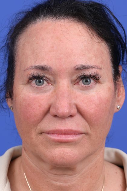 Lower Deep Plane Facelift Before & After Patient #10639