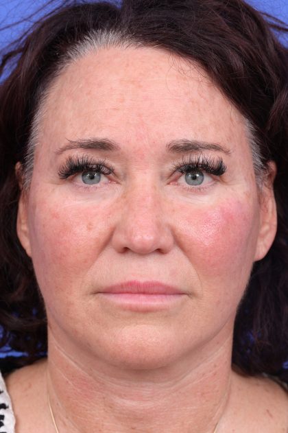 Lower Deep Plane Facelift Before & After Patient #10639