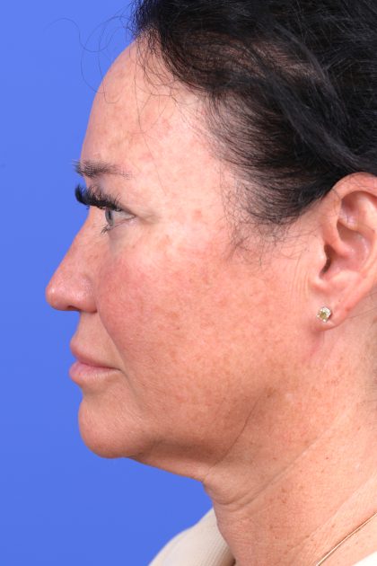 Lower Deep Plane Facelift Before & After Patient #10639