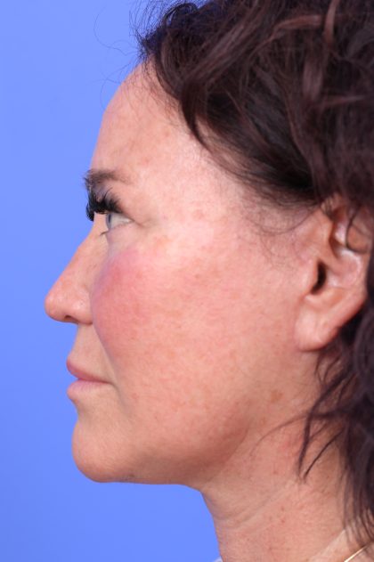 Lower Deep Plane Facelift Before & After Patient #10639